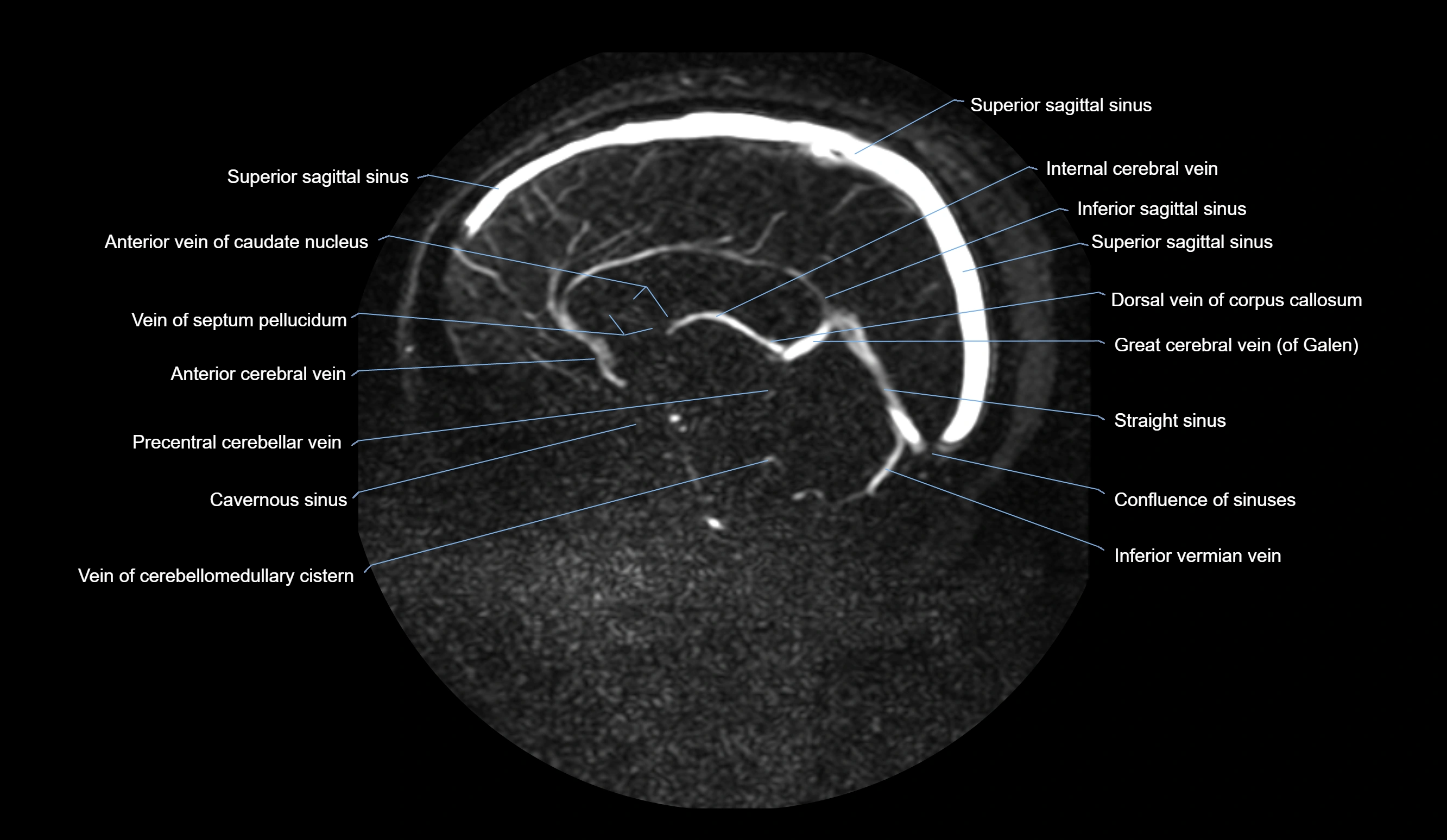 MRV brain sagittal anatomy 3T MRI labelledimages -00044.webp